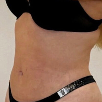 plasmova-liposukce-1-po (1)