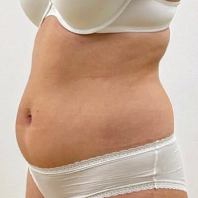 plasmova-liposukce-1-pred (1)