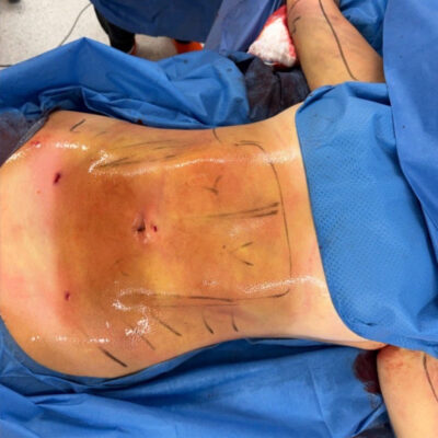 plasmova-liposukce-11-po