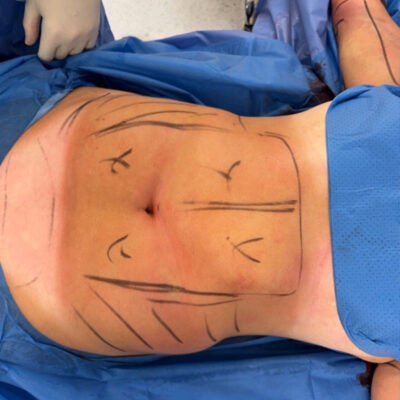 plasmova-liposukce-11-pred