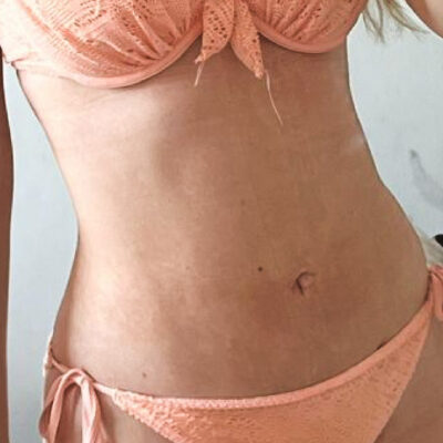 plasmova-liposukce-13-po (1)