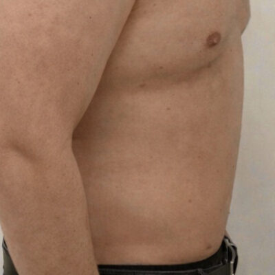 plasmova-liposukce-15-po (1)