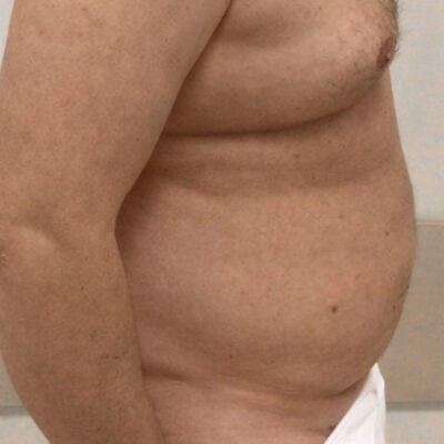 plasmova-liposukce-15-pred (1)