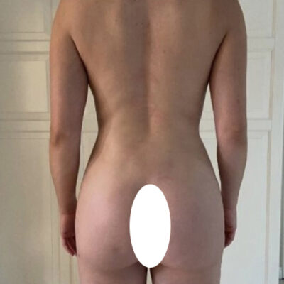 plasmova-liposukce-16-po