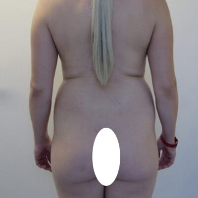 plasmova-liposukce-16-pred