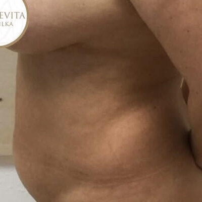 plasmova-liposukce-17-pred (1)