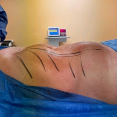 plasmova-liposukce-18-pred