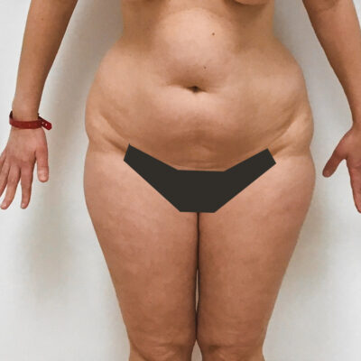 plasmova-liposukce-2-pred