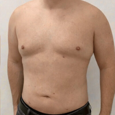 plasmova-liposukce-3-po