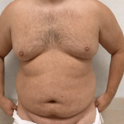 plasmova-liposukce-3-pred