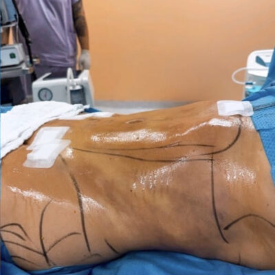 plasmova-liposukce-5-po