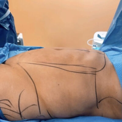 plasmova-liposukce-5-pred