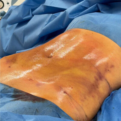 plasmova-liposukce-6-po