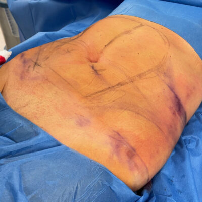 plasmova-liposukce-6-pred