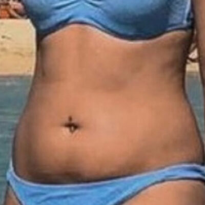 plasmova-liposukce-7-pred (1)