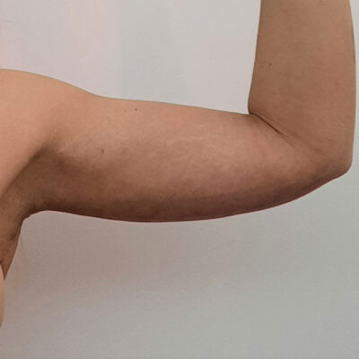 plasmova-liposukce-8-po