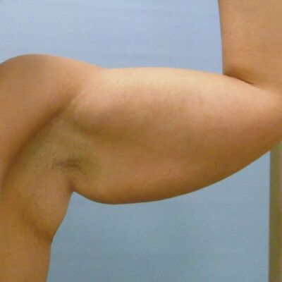 plasmova-liposukce-8-pred