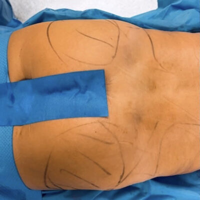 plasmova-liposukce-9-pred