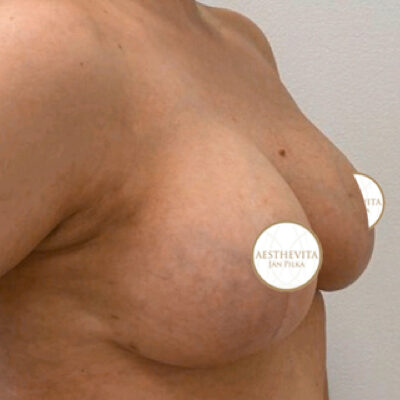 19b_modelace_prsou_aesthevita_pilka-po