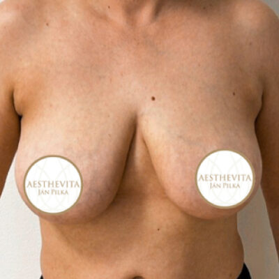 20a_modelace_prsou_aesthevita_pilka-pred