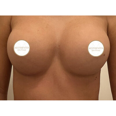 38a_zvetseni prsou_aesthevita_pilka-po