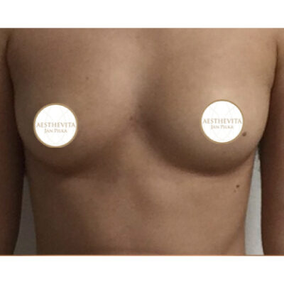 38b_zvetseni prsou_aesthevita_pilka-pred