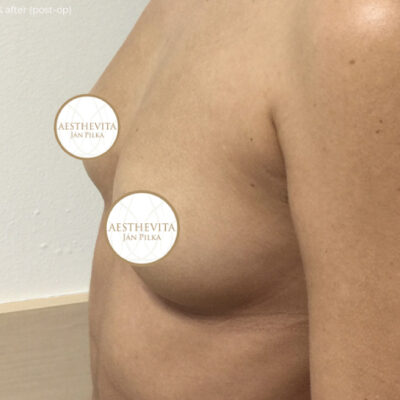 39a_zvetseni prsou_aesthevita_pilka-pred