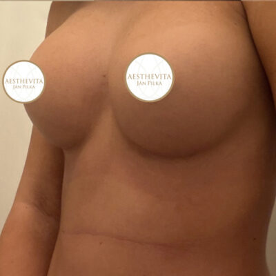 39b_zvetseni prsou_aesthevita_pilka-po