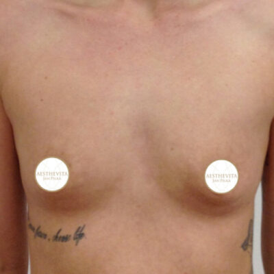 zvetseni-prsou-implantaty-0-pred