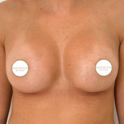 zvetseni-prsou-implantaty-13-po