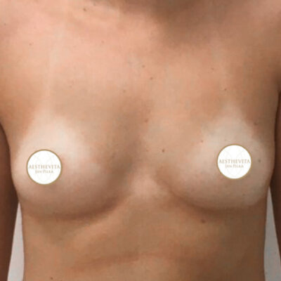 zvetseni-prsou-implantaty-13-pred