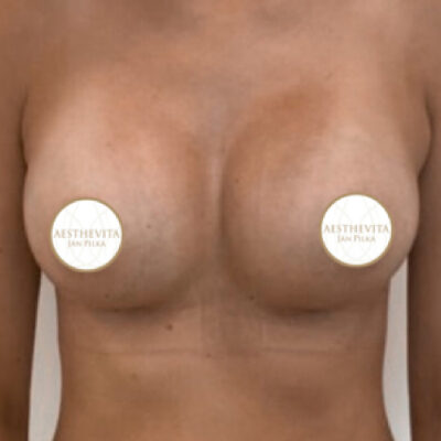 zvetseni-prsou-implantaty-14-po