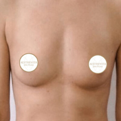 zvetseni-prsou-implantaty-14-pred