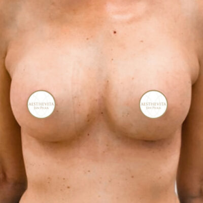 zvetseni-prsou-implantaty-15-po