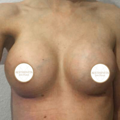 zvetseni-prsou-implantaty-16-po