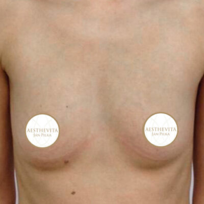 zvetseni-prsou-implantaty-16-pred