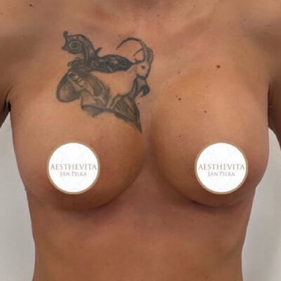 zvetseni-prsou-implantaty-19-po