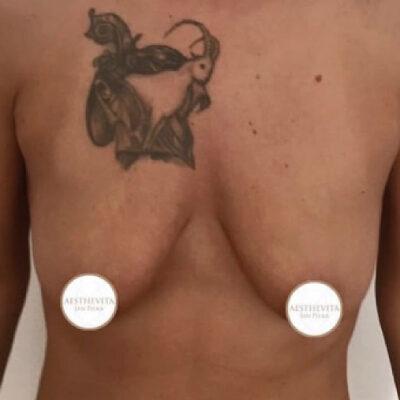 zvetseni-prsou-implantaty-19-pred