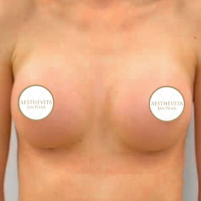 zvetseni-prsou-implantaty-20-po