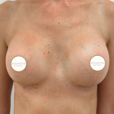 zvetseni-prsou-implantaty-21-po