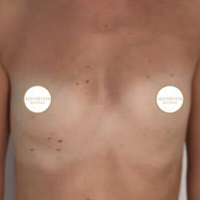 zvetseni-prsou-implantaty-21-pred