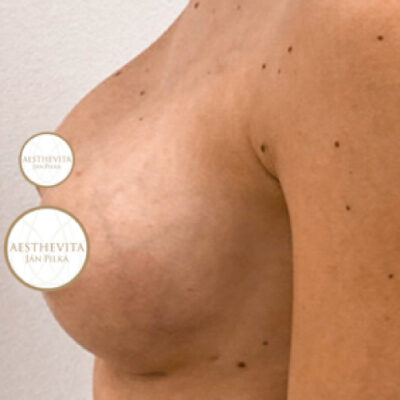 zvetseni-prsou-implantaty-23-po