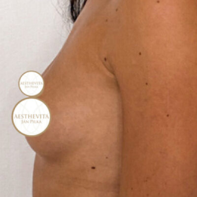 zvetseni-prsou-implantaty-23-pred