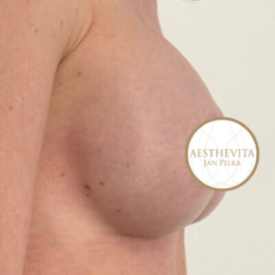 zvetseni-prsou-implantaty-24-po