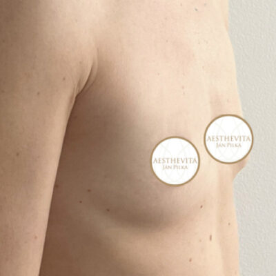 zvetseni-prsou-implantaty-24-pred