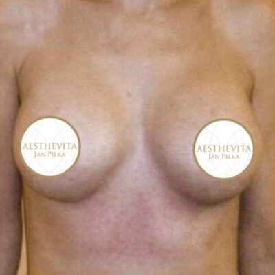 zvetseni-prsou-implantaty-25-po