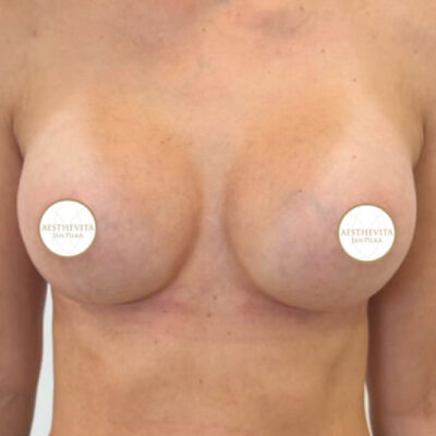 zvetseni-prsou-implantaty-27-po