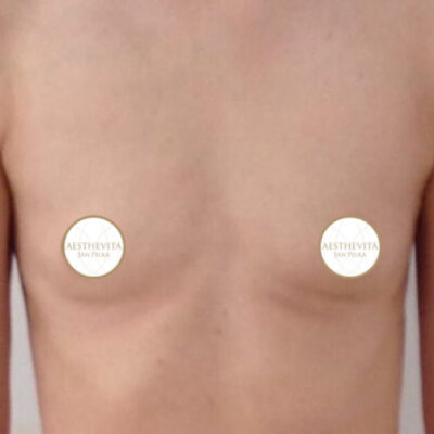 zvetseni-prsou-implantaty-27-pred