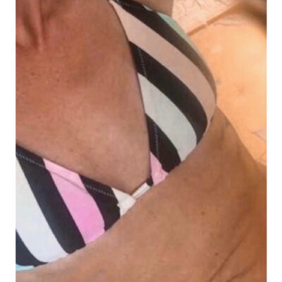 zvetseni-prsou-implantaty-29-pred