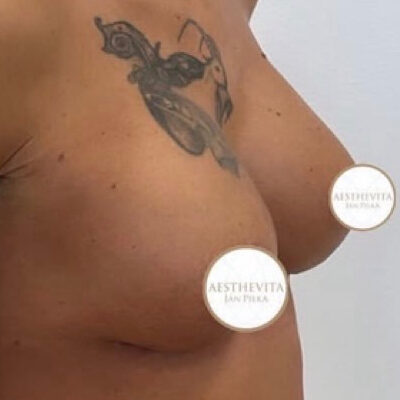 zvetseni-prsou-implantaty-30-po